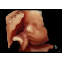 GE Healthcare Voluson E6 УЗИ аппарат стационарный — фото 3