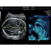 GE Healthcare Voluson P8 УЗИ аппарат стационарный — фото 6